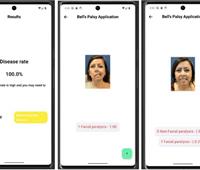 Bell's Palsy detection App using CNN model